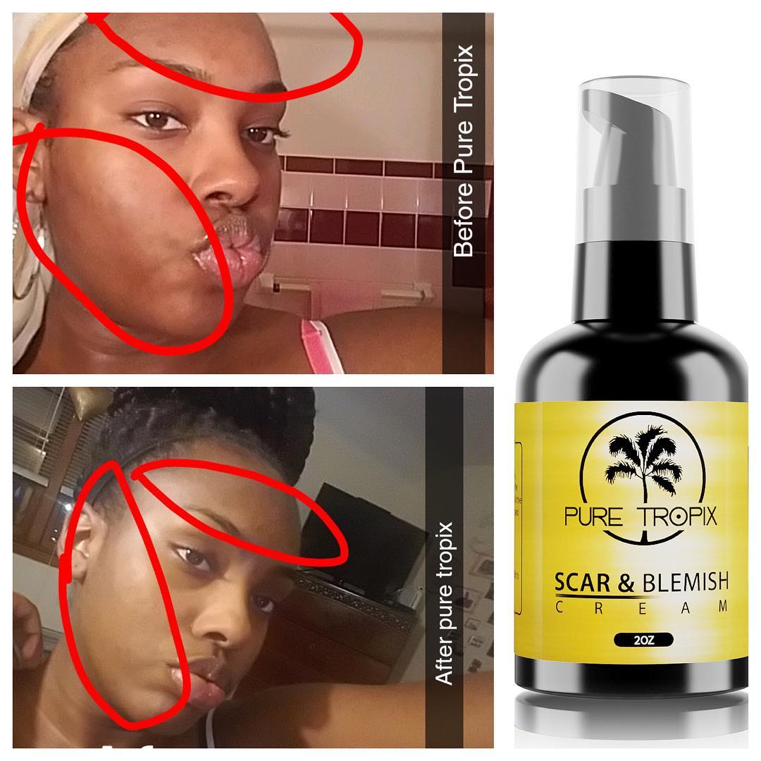 3 Steps to Get Rid of Hyper Pigmentation