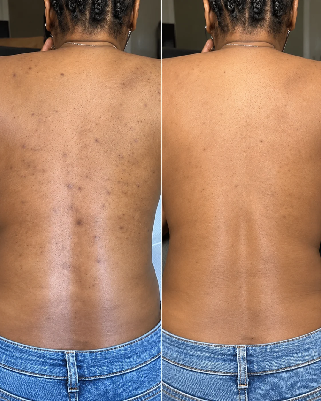 Scar & Blemish Cream